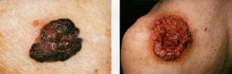 Melanoma (left) is less common tha-n basal cell carcinoma (right) but it is far more aggressive. Left: ©James Stevenson, Science Photo Library/Photo Researchers, Inc. Right: © M Abbey/Photo Researchers, Inc.