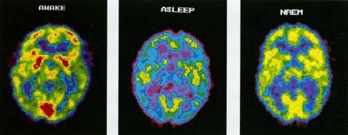 Researchers use electroencephalograms (EEGs) and positron emission tomography (PET scans) to study sleep disorders. These PET scans show various stages of sleep and wakefulness. When awake (left), the brain shows active areas in red and yellow, with inactive areas in blue. During normal sleep (center), the brain is less active, and most areas show as blue. During deep sleep and non-REM sleep (right), the brain is active but not as active as during REM sleep (not shown) or wakefulness. © Hank Morgan, Science Source/Photo Researchers, Inc.