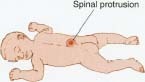 Babies born with spina bifida often have an unprotected opening at the back of the spine.