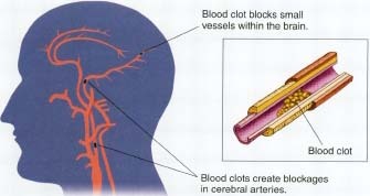 A blockage in an artery that supplies blood to the brain can cause an ischemic stroke.