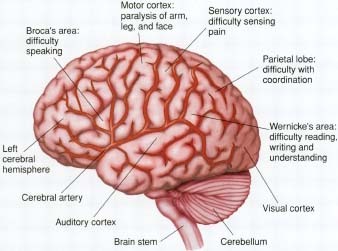 Strokes can affect many different parts of the brain.