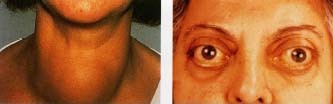 Goiter of the neck (left). © 1991 National Medical Slide/Custom Medical Stock Photo. Exophthalmos (bulging) of the eyes in Graves' disease (right). © 1992 Chet Childs/Custom Medical Stock Photo.
