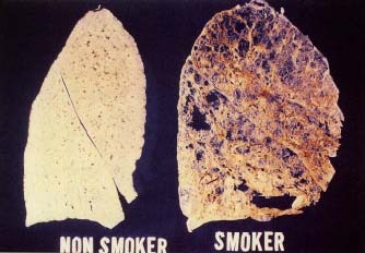 Healthy lung of a nonsmoker compared with damaged lung of a smoker. © O. Auerbach, Visuals Unlimited.