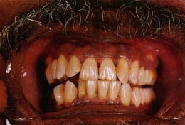 Teeth and gums of a smoker stained from tobacco. No one will want to kiss someone like this. © 1997 Custom Medical Stock Photo.