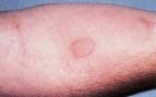 The red spot on the arm indicates a positive skin test forTB. Ken Greer/Visuals Unlimited