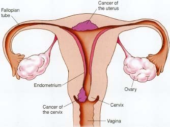 Anatomy of the female reproduction system showing cervical and uterine cancers.