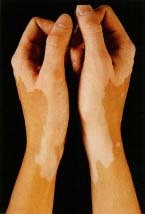 This young woman has vitiligo on her wrists, hands, and thumbs. She does not use makeup to cover it. 1997 Custom Medical Stock Photo.