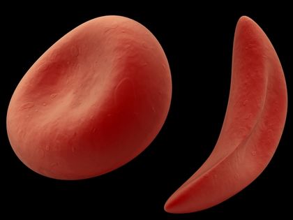Sickle Cell Anemia 2373